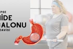 Allurion Mide Balonu